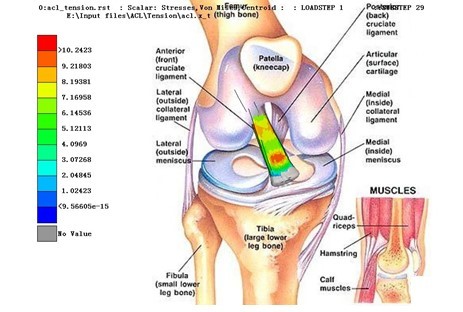 Simulation Analysis of Anterior Cruciate Ligament (Figure 4)