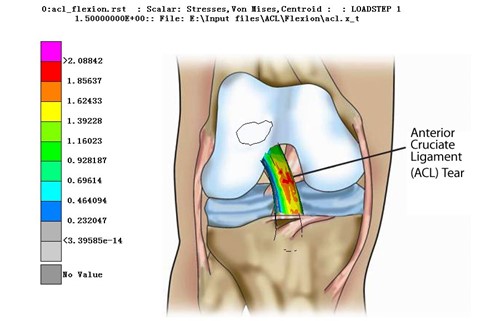 Simulation Analysis of Anterior Cruciate Ligament (Figure 6)