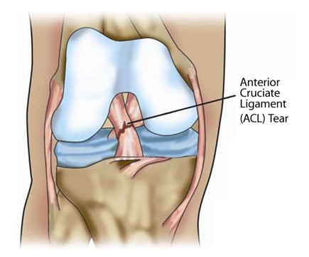 Simulation Analysis of Anterior Cruciate Ligament (Figure 7)