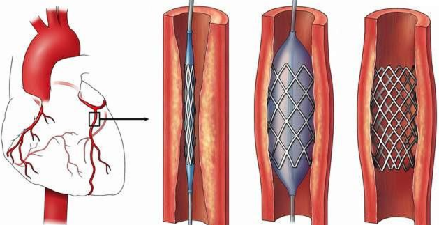 Finite Element Simulation of the Deformation of Medical Vascular Stents (Figure 1)